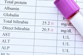 Đọc kết quả xét nghiệm Biliburin 